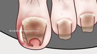 ASMR Ingrown Toenail Removal Treatment Animation Strong Satisfaction || Meng Stop Motion