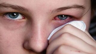 Conjunctivitis epidemic uncontrollable in Punjab