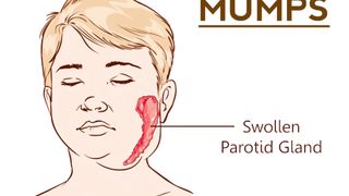 Mumps Symptoms, Causes, Diagnosis & Treatment