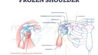 Frozen shoulder, Adhesive Capsulitis