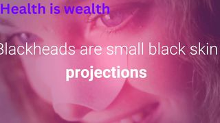 How to Remove Blackheads Naturally