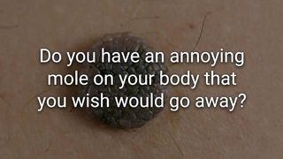 How to Remove a Mole Quickly With Castor Oil