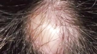 cyst/cyst in head/pilar cyst /pilar cyst treatments/ pilar cyst shampoo/trichilemmal cyst #cyst
