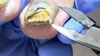 germs are 10 cm thick【Doctor Liu Pedicure】
