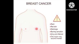 breast cancer/breast cancer treatment/awareness, prevention ,symptom's ,cause ,diagnosis, treatments