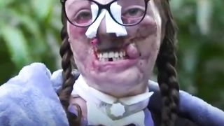 A dog destroyed her face with its bite.