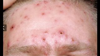What is Chicken Pox When is this infection most common