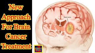 Brain cancer Hundreds of children could benefit from new approach to treatment