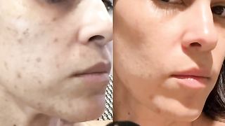 How many of you suffer from melasma