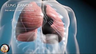 SIGNS OF LUNG CANCER