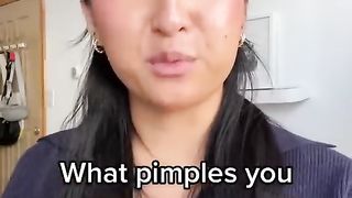 What pimples you SHOULD and SHOULDN’T pop?