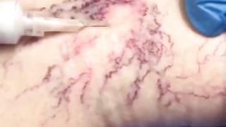 Satisfying Magic Eraser Sclerotherapy