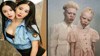 10 Most Unique Twins in The World