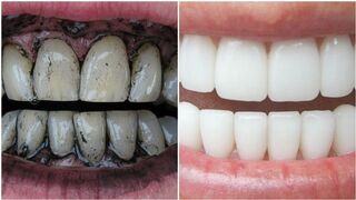 3 Way to Whiten Your Yellow Teeth Naturally