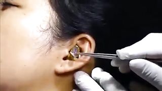 Chirurgien'_struggles_to_remove_live_snake_from_woman's_ear_in_viral_video (480p).