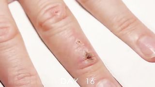 Wound Healing Time Lapse