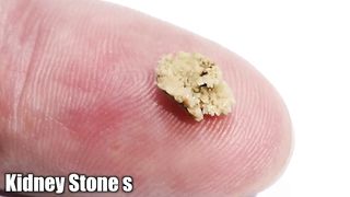 How To Dissolve Kidney Stones Explained By Dr.Berg