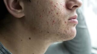 The Top Vitamin Deficiency with Acne