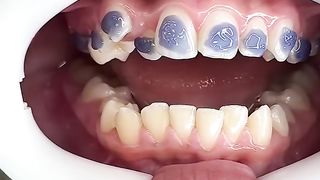 Putting Braces On.