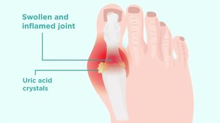 The #1 Best Protocol for Gout