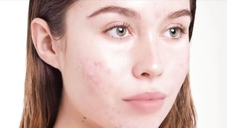The FASTEST Way to Rid Acne - Dr. Berg