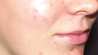 Say Goodbye to Acne: Dr. Berg's Proven Methods for Clearing Your Skin