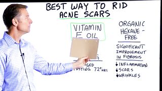 Best Way to Rid Acne Scars