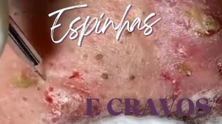 ESPINHA E CRAVO NAS COSTAS ESPREMENDO GIGANTE PIMPLE AMAZING
