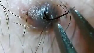 ほくろの毛を引っこ抜く！part11 Hair of a mole!