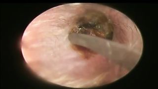 BIGGEST Earwax, Difficult Removal EP9 | Doctor Anh