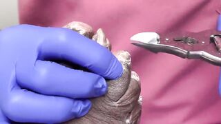 CUTTING OF SUPER THICK, LONG & CRUSTY TOENAILS - 002