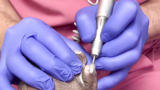 CUTTING OF SUPER THICK, LONG & CRUSTY TOENAILS - 006