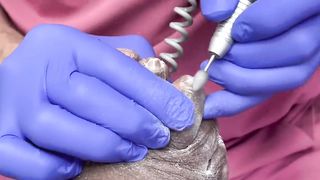 CUTTING OF SUPER THICK, LONG & CRUSTY TOENAILS - 007