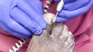 CUTTING OF SUPER THICK, LONG & CRUSTY TOENAILS - 008