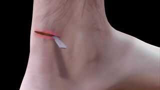 Achilles Tendon Repair