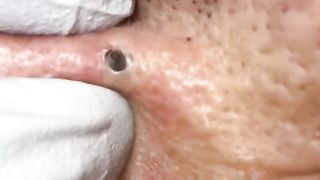Big blackhead