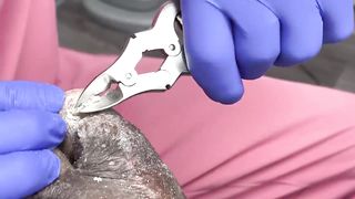 CUTTING OF SUPER THICK, LONG & CRUSTY TOENAILS - 014