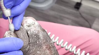 CUTTING OF SUPER THICK, LONG & CRUSTY TOENAILS - 015