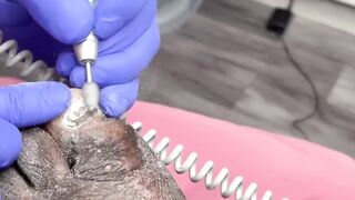 CUTTING OF SUPER THICK, LONG & CRUSTY TOENAILS - 016