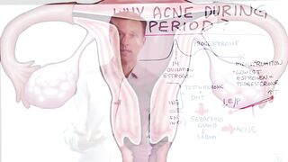 Why Do You Get Acne During Your Period (Menstruation)