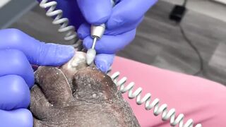 CUTTING OF SUPER THICK, LONG & CRUSTY TOENAILS - 017
