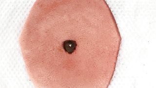 BEST Pimple Popping __ Big Cystic Acne Blackheads __ Whiteheads Removal _ Squeezing Pimples _ H#064 - 00