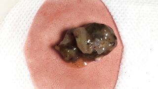 BEST Pimple Popping __ Big Cystic Acne Blackheads __ Whiteheads Removal _ Squeezing Pimples _ H#064 - 002