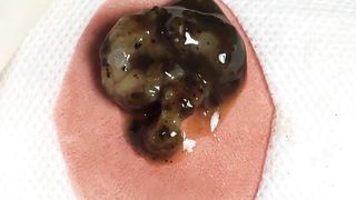 BEST Pimple Popping __ Big Cystic Acne Blackheads __ Whiteheads Removal _ Squeezing Pimples _ H#064 - 003