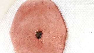 BEST Pimple Popping __ Big Cystic Acne Blackheads __ Whiteheads Removal _ Squeezing Pimples _ H#064 - 004