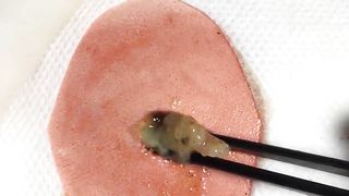 BEST Pimple Popping __ Big Cystic Acne Blackheads __ Whiteheads Removal _ Squeezing Pimples _ H#064 - 005