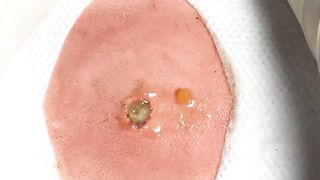 BEST Pimple Popping __ Big Cystic Acne Blackheads __ Whiteheads Removal _ Squeezing Pimples _ H#064 - 006