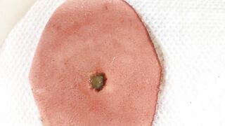 BEST Pimple Popping __ Big Cystic Acne Blackheads __ Whiteheads Removal _ Squeezing Pimples _ H#064 - 007