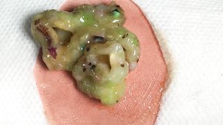 BEST Pimple Popping __ Big Cystic Acne Blackheads __ Whiteheads Removal _ Squeezing Pimples _ H#064 - 008