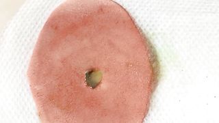 BEST Pimple Popping __ Big Cystic Acne Blackheads __ Whiteheads Removal _ Squeezing Pimples _ H#064 - 009